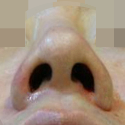 수술 후 이미지